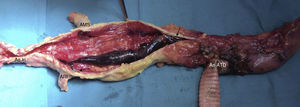 Necropsia. Trombo en transición toracoabdominal con oclusión de ostium de AMS (desprendido durante la manipulación en la necropsia) y de ARI. AMS: arteria mesentérica superior; An ATD: anastomosis aorta torácica descendente; Ao In: aorta infrarrenal; ARI: arteria renal izquierda.