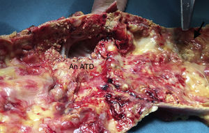 Necropsia. «Shaggy aorta»; zona de origen del trombo (flecha) tras retirada del mismo a nivel del pinzamiento distal de la ATD. An: anastomosis proximal; ATD: aorta torácica descendente.