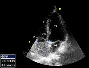 Invasión del volumen de la aurícula derecha por el trombo tumoral (AD: aurícula derecha; AI: aurícula izquierda; VD: ventrículo derecho; VI: ventrículo izquierdo) en el ecocardiograma transtorácico.