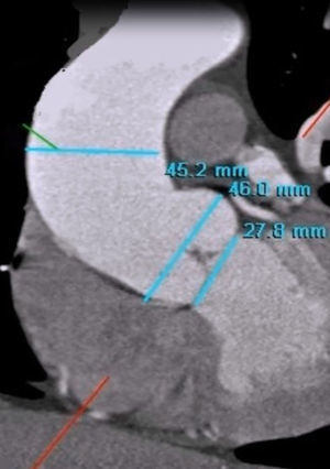 Angio-TC con medidas de anillo aórtico, senos de valsalva y aorta ascendente.