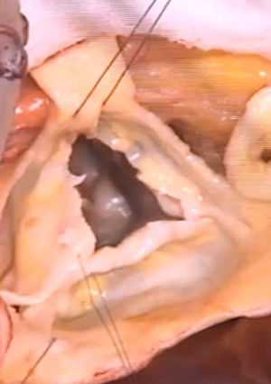 Imagen de válvula sin el tejido displásico que se ha resecado, casi todo el velo coronariano derecho y parte del no coronariano.