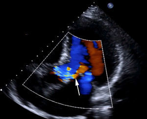 Ecocardiograma transtorácico preoperatorio. Jet de insuficiencia aórtica preoperatoria severa (flecha blanca).