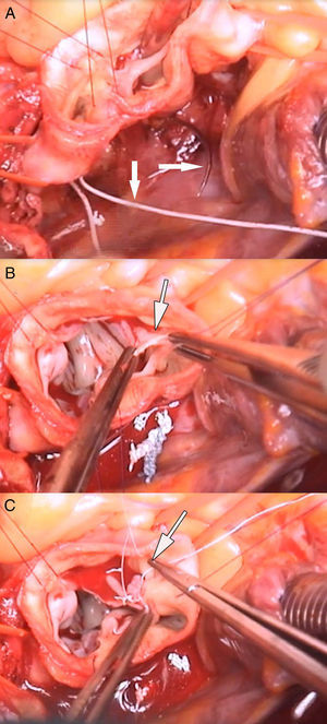 A) Anuloplastia (flecha blanca señala aguja de sutura). B) Rotura del velo coronariano derecho en su inserción en la comisura (flecha blanca). C) Sutura de velo con refuerzo de pericardio (flecha blanca).