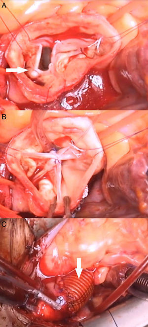 A) Plicatura central de velo coronariano izquierdo (flecha blanca). B) Comprobación de velos con punto central. C) Tubo supracoronario (flecha blanca).