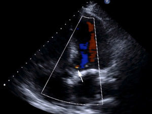 Ecocardiograma transtorácico al alta. La insuficiencia aórtica postoperatoria es leve (flecha blanca).