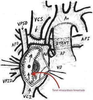 Técnica quirúrgica túnel intracardiaco.
