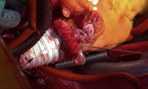 Resección quirúrgica de la VCS proximal y tubo de Dacron® (flecha) interpuesto desde la AD hasta la VCS. AD: aurícula derecha; RMC: resonancia magnética cardiaca; SIA: septo interauricular; VCS: vena cava superior.