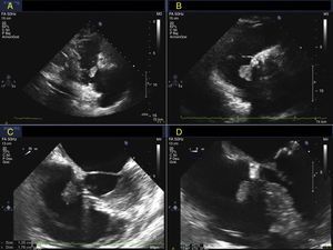 (A) and (B) TTE polypoid mass in the right atrium attached to the septal leaflet of the tricuspid valve. (C) and (D) Transesophageal echocardiography confirmed de previous findings.