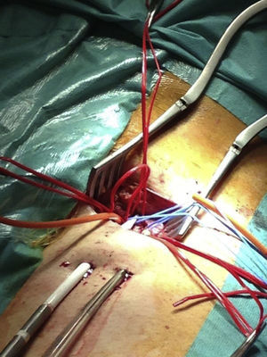 Implantación de ECMO veno-arterial femoral con identificación de vasos.