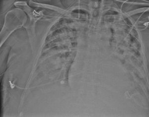 Radiografía de tórax: distrés respiratorio.