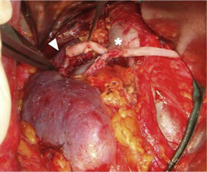 Bypass aorto-renal con vena safena (punta de flecha) y reimplante de arteria polar inferior (*).