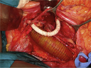 Prótesis de Dacron en la aorta abdominal, prótesis de politetrafluoroetileno expandido con anastomosis proximal en la arteria mesentérica superior y que se dirige hacia el riñón izquierdo.