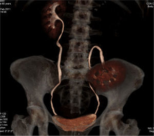 Tomografía computarizada con reconstrucción 3D: autotransplante heterotópico sin sección de uréter.