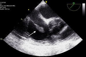 . Ecocardiograma transesofágico que muestra una masa pediculada anclada a la unión cavo-auricular inferior.