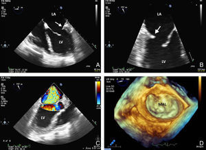 A) Apical 4-cámaras, imagen de ecocardiografía transtorácica. La flecha señala el remanente del velo posterior mitral hipoplásico (Ao: aorta; LA: aurícula izquierda; LV: ventrículo izquierdo). B y C) Imagen de ecocardiografía transesofágica eje largo. D) Reconstrucción tridimensional ecocardiográfica «surgical view».