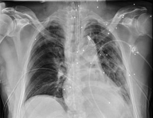Radiografía anteroposterior de tórax, al ingreso, donde se objetiva la siembra de perdigones localizada especialmente en hemitórax izquierdo.