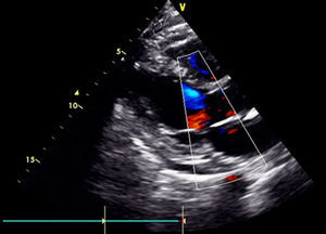 Ecocardiograma transtorácico. Evidencia derrame pericárdico moderado (12mm).