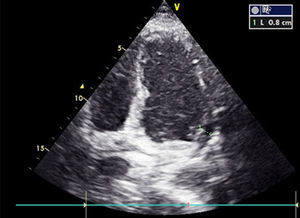 Ecocardiograma transtorácico durante el seguimiento, que muestra la progresiva disminución del derrame pericárdico (0,8mm).