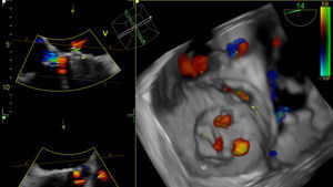 Ecocardiograma transesofágico: corte 3D que muestra paso de color a nivel de septo membranoso (flecha).