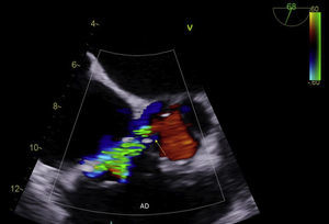 Doppler color que muestra cortocircuito entre VI y AD (flecha).