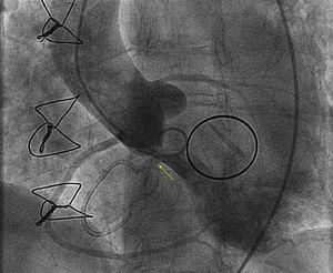 Ventriculografía donde se muestra paso de contraste de VI a AD (flecha).