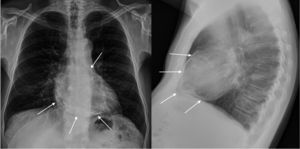 Radiografía de tórax. Se señala el saco pericárdico rodeando al corazón.