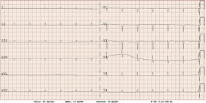 Electrocardiograma que demuestra bajo voltaje en derivaciones de miembros.