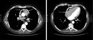 La tomografía computarizada demuestra intensa calcificación del saco pericárdico.