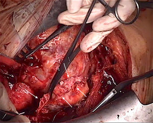 Pericardiectomía. Liberación de la zona que rodea la aurícula derecha.