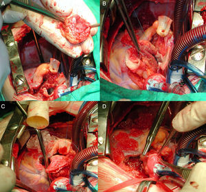Imágenes intraoperatorias de estenosis subaórtica compleja que requirió cirugía de Ross-Konno para resolverla. A) Extracción del autoinjerto pulmonar completa. B) Sutura proximal del autoinjerto en el tracto de salida del ventrículo izquierdo. C) Comienza la sutura distal del conducto heterólogo con las ramas pulmonares, en el autoinjerto ya se ha anastomosado la coronaria izquierda. D) Final de la anastomosis de la coronaria derecha en el autoinjerto.