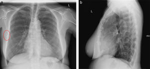 a) Radiografía de tórax postero-anterior. Nótese la imagen en hemitórax derecho. b) Radiografía de tórax en proyección lateral. Hilo radioopaco sugiriendo cuerpo extraño.