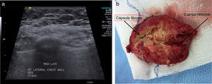 a) Estudio ecográfico sugiriendo masa hipoecoica. b) Pieza quirúrgica. Cápsula fibrosa y cuerpo retenido.