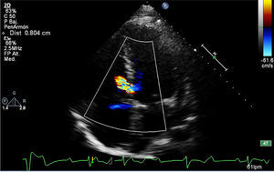 Ecocardiograma que muestra lesión del septum interventricular con defecto de 8mm.