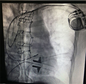 La imagen muestra fijación de fractura esternal e implantación de marcapasos bicameral definitivo.