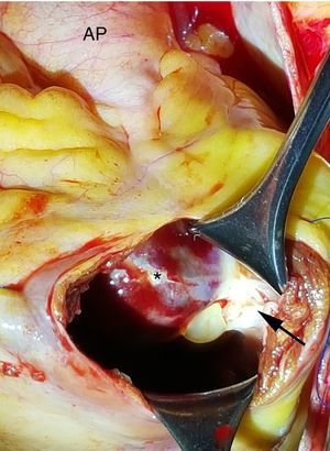 Imagen intraoperatoria de la ventriculotomía derecha vista desde el cirujano. Se aprecia el tumor (*) fijo al septo interventricular por un pedículo (flecha). El tumor se extiende hacia el tronco de la arteria pulmonar (AP).