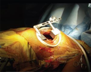 Técnica minimally invasive direct coronary artery bypass (MIDCAB).