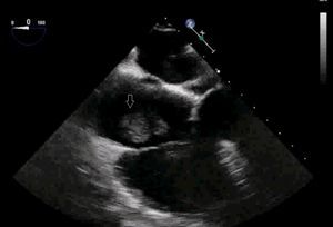 Ecocardiografía transesofágica intraoperatoria. Plano medio-esofágico de 4cámaras. Se observa masa que protuye en aurícula derecha.