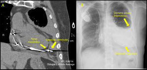 A) TAC torácico. Perforación miocárdica por electrodo de cable ventricular. Electrodo atravesando el espesor miocárdico en 4cm de longitud. Hemotórax secundario. Ausencia de derrame pericárdico. B) Radiografía de tórax. Derrame pleural izquierdo compatible con Hemotórax secundario a perforación miocárdica por electrodo de cable ventricular.