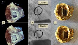 A) Ecocardiograma transesofágico. Visión del cirujano (desde la aurícula izquierda). B) Fluoroscopia. C) Válvula mecánica explantada.