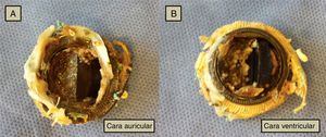 A y B) Caras auricular y ventricular de la válvula explantada.