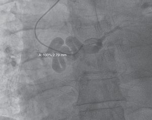 En la coronariografía preoperatoria se objetiva la arteria circunfleja de la que nace una gran fístula, prácticamente a su salida del tronco coronario izquierdo, donde mide casi 9mm de diámetro, a la cava superior, con un trayecto tortuoso de unos 5-6mm de diámetro y una desembocadura en la cava superior de unos 2-3mm de diámetro.