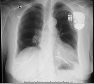 Radiografía de tórax, proyección AP. Se observa el electrodo activo aparentemente fuera del corazón.