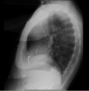 Radiografía de tórax, proyección lateral. Se observa el electrodo activo aparentemente fuera del corazón.