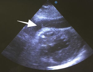 Ecocardiograma. Se identifica claramente derrame pericárdico importante (flecha blanca) con colapso del ventrículo derecho.