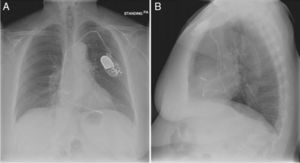Radiografía de tórax anteroposterior (A)-lateral (B). Adecuado posicionamiento de los electrodos en la aurícula y ventrículo derechos7.