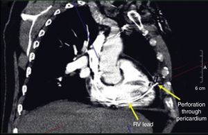 Tomografía computarizada de tórax, en la que observamos el electrodo de fijación activa a través del corazón, indicando su trayectoria con las flechas amarillas en el ventrículo derecho y pericardio25.