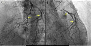 A) Lesión de la arteria descendente anterior y la diagonal (flechas). B) Lesión del tronco coronario izquierdo y la circunfleja (flechas).