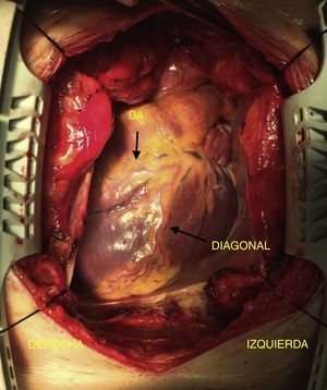 Imagen intraoperatoria donde se evidencia el ápex del corazón orientado hacia la derecha, así como la distribución de la arteria descendente anterior (DA) y la diagonal.