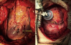 A) Arteria descendente anterior (DA) y diagonal revascularizadas con la arteria mamaria interna derecha (AMID). B) Arteria obtusa marginal (OM) revascularizada con la arteria mamaria interna izquierda (AMII).