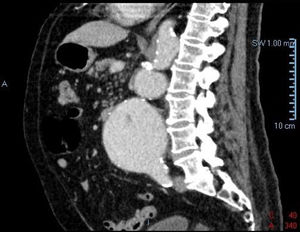 Angio-TC de aorta abdominal (corte sagital). Se visualiza un aneurisma sacular de la aorta abdominal, involucrando las arterias renales, y un aneurisma fusiforme (80mm) de la aorta abdominal debajo del nivel de las arterias renales.